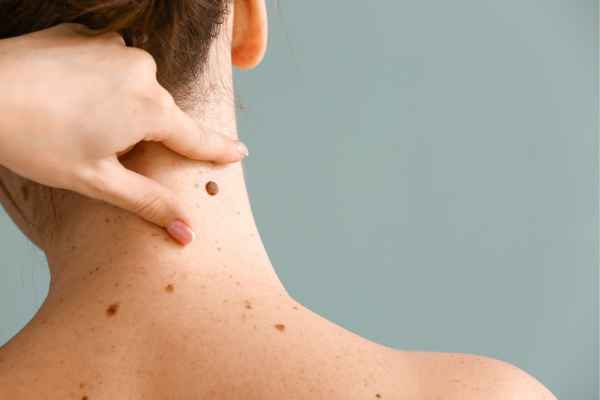 Mole Removal