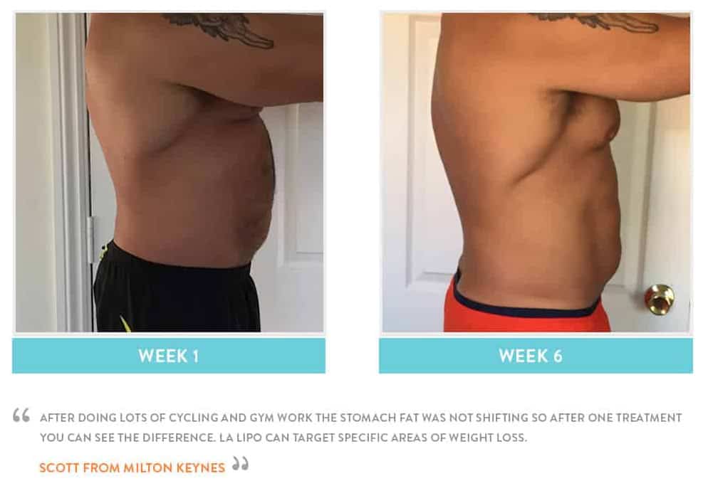 Before & After Stomach Fat Greater London (Hackney)