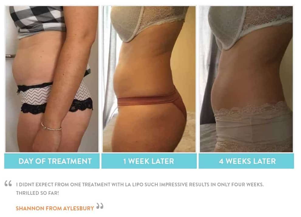 before, Cryolipolysis Greater London (Hackney)