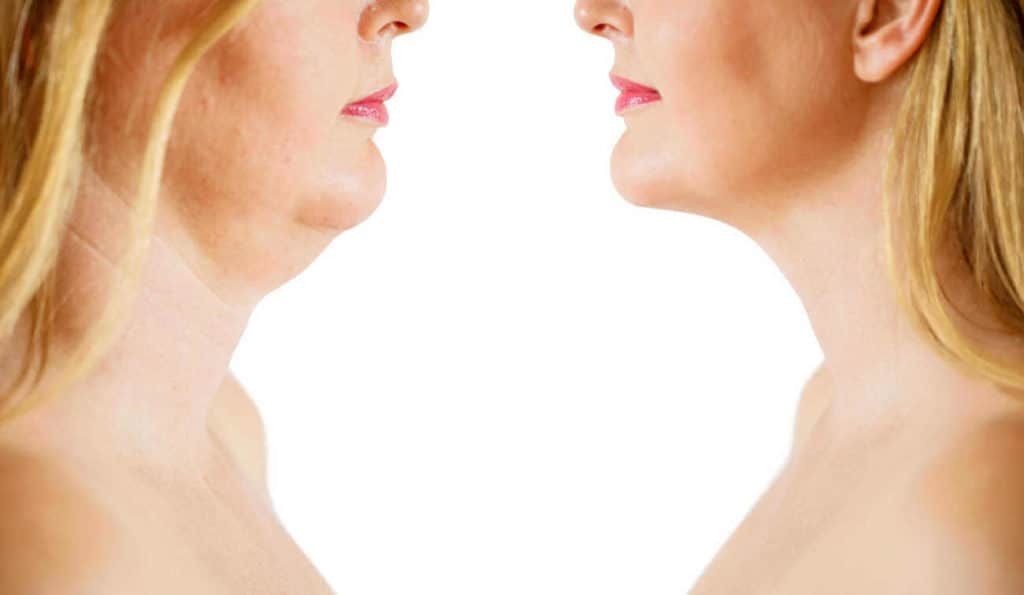 Double Chin treatment Greater London (Hackney) before and after results