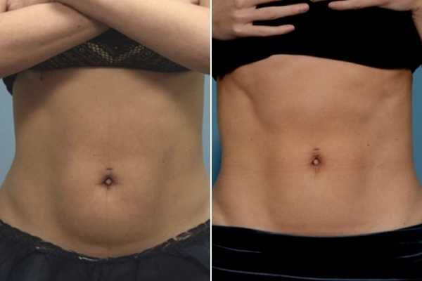 body sculpting FAQs Greater London (Hackney)