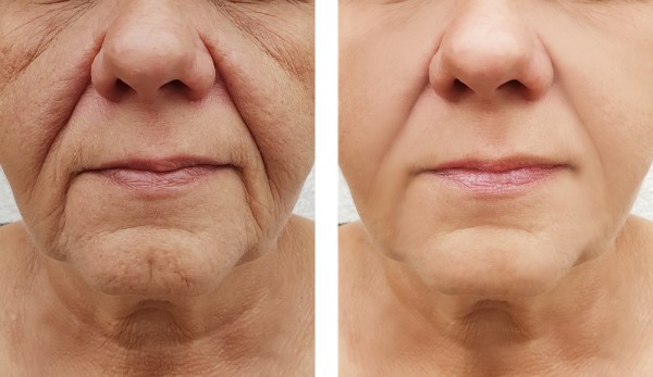 Learn more about Morpheus8 Treatment Greater London (Hackney) today!