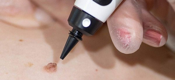 After Skin Tag Removal Greater London (Hackney)