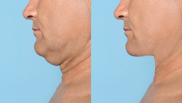 Which Non-Surgical Treatments Work Best for Jowls and Loose Skin Greater London (Hackney)?