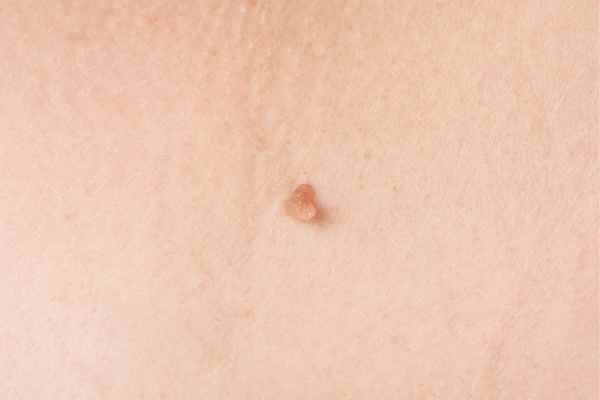 skin tag