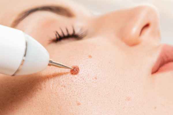 How Does CryoPen Remove Dermatofibromas Step by Step?