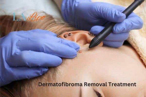 Dermatofibroma Removal Treatment Greater London (Hackney)