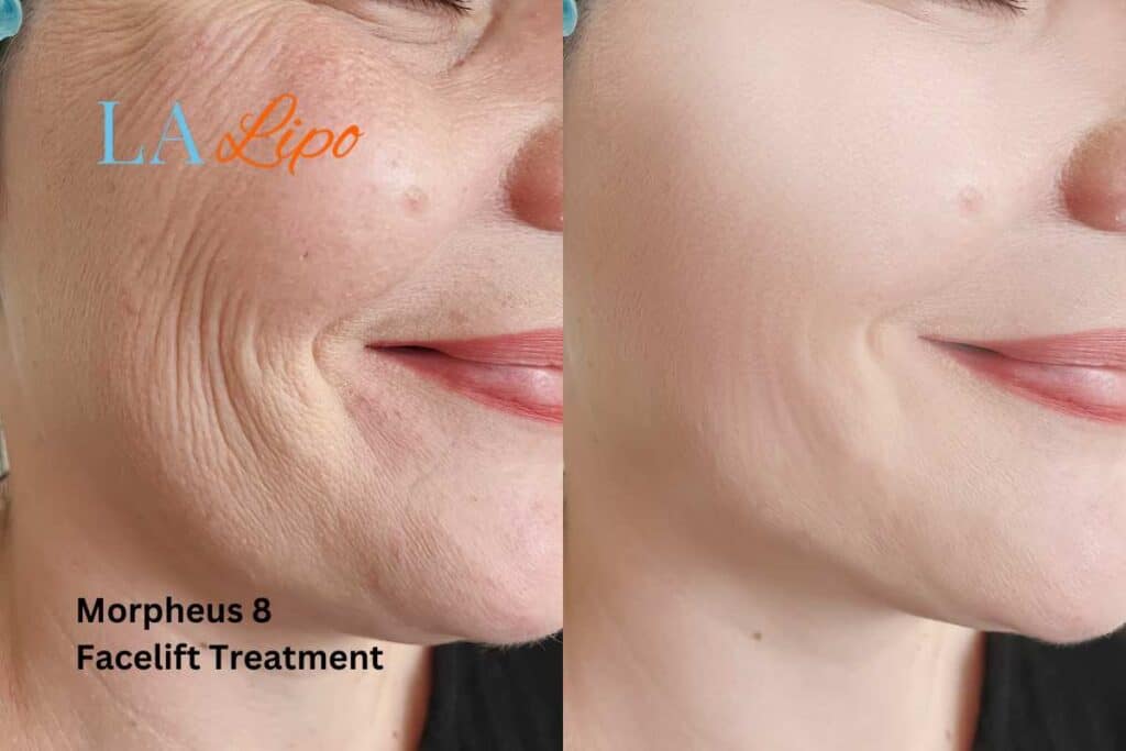 Morpheus8 Treatment Greater London (Hackney) for flawless skin! Call us today!