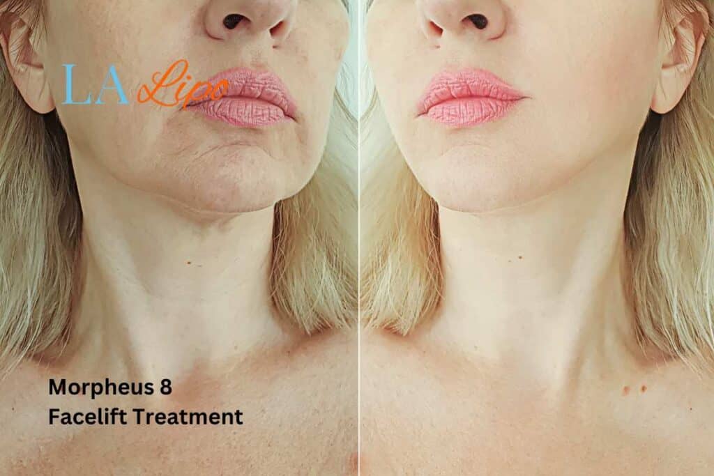 Turn back time with Morpheus8 Treatment Greater London (Hackney)