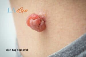 skin tag