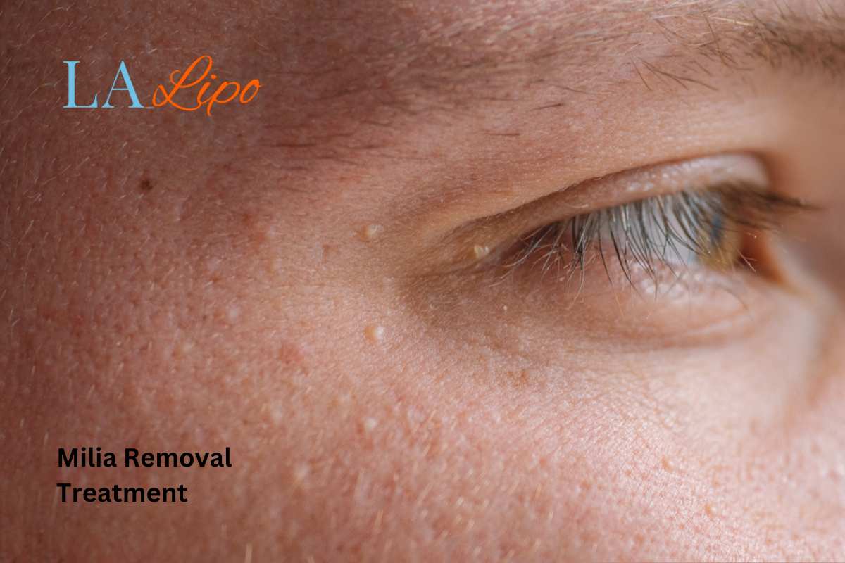 Cryopen Milia Removal: Is It the Easiest and Safest Option Greater London (Hackney)?
