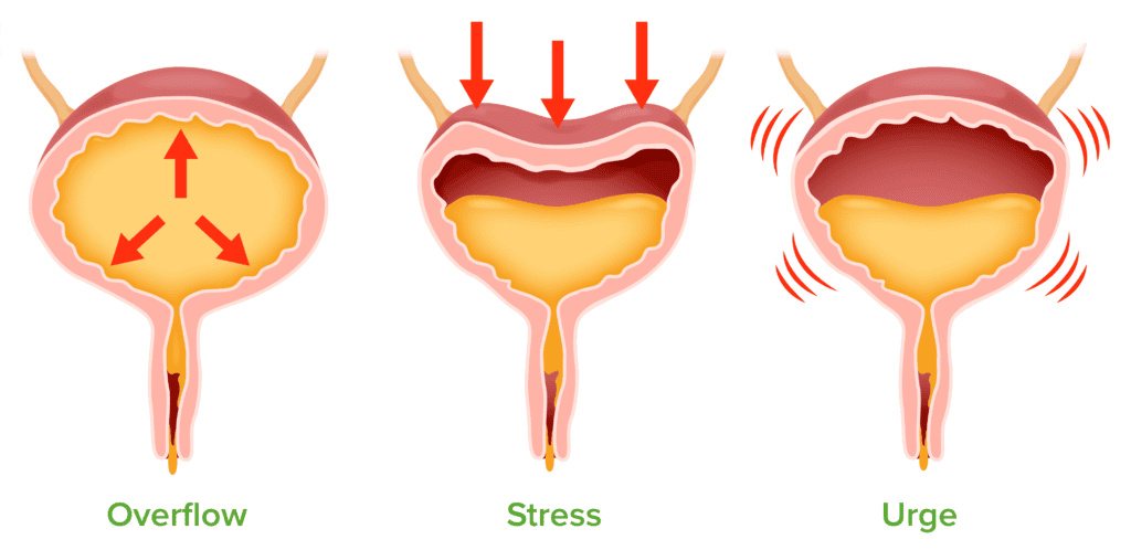 Overactive Bladder and Incontinence
