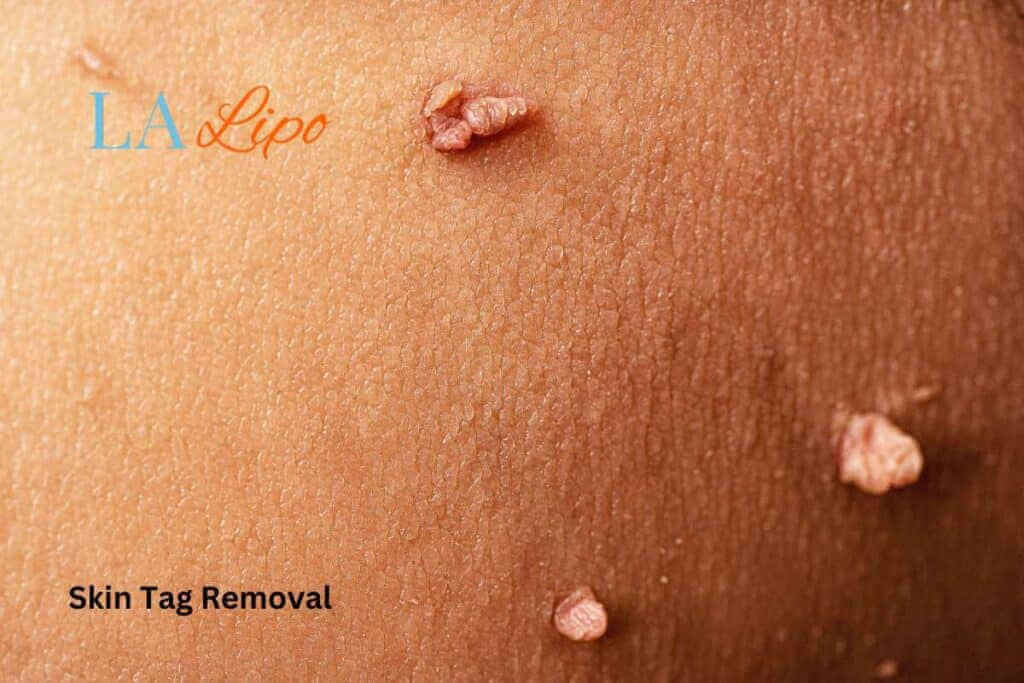 Skin Tag Removal