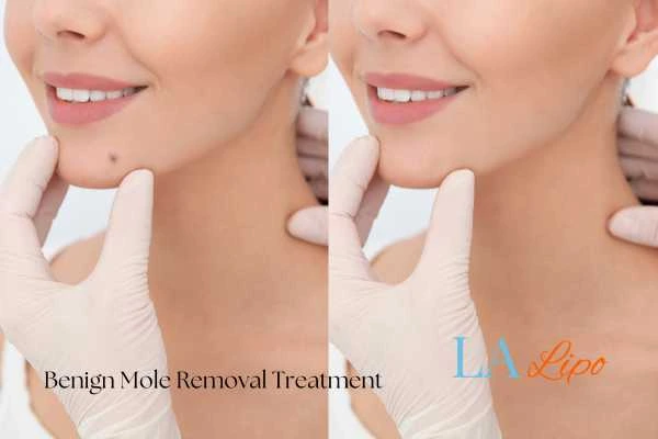 woman's before and after mole removal Greater London (Hackney) results