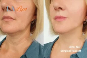 hi-fu for wrinkles Greater London (Hackney) before and after results