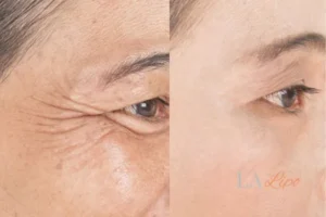 Before and after results of woman - HI-fu wrinkles reduction treatment Greater London (Hackney)