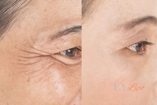 Before and after results of woman - HI-fu wrinkles reduction treatment Greater London (Hackney)