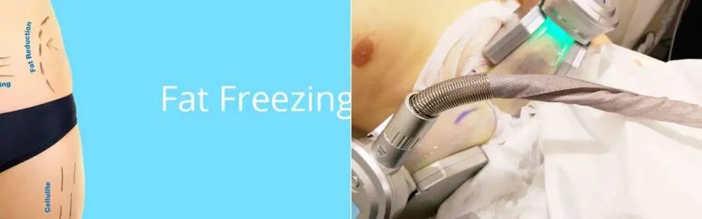 Fat freezing Greater London (Hackney) on multiple areas of the body