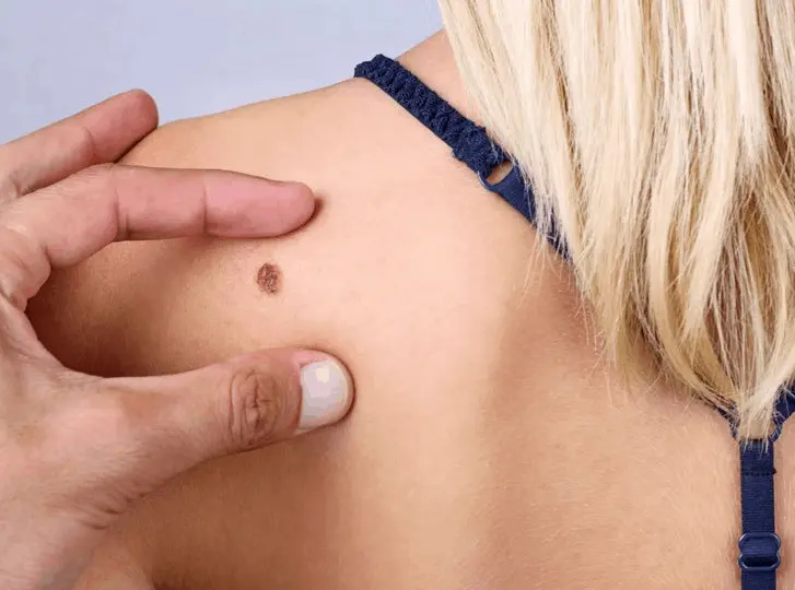 woman having mole removal Greater London (Hackney) consultation before treatment.