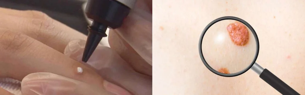 CryoPen practitioner Greater London (Hackney) assessing a benign mole before treatment
