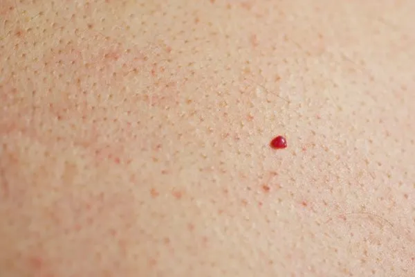 close up of a cherry angioma Greater London (Hackney)