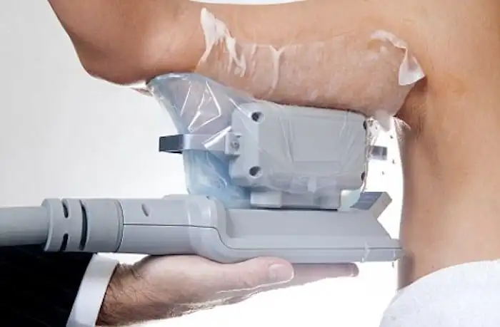 Picture of fat freezing Greater London (Hackney) on the upper arms.