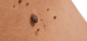 image of a skin tag Greater London (Hackney)