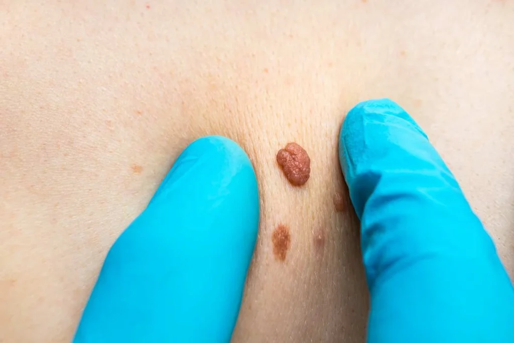 Consultant examining a skin tag Greater London (Hackney)