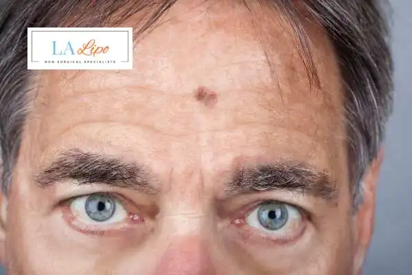 Solar Lentigo Removal Greater London (Hackney) image of man with mark on his forehead