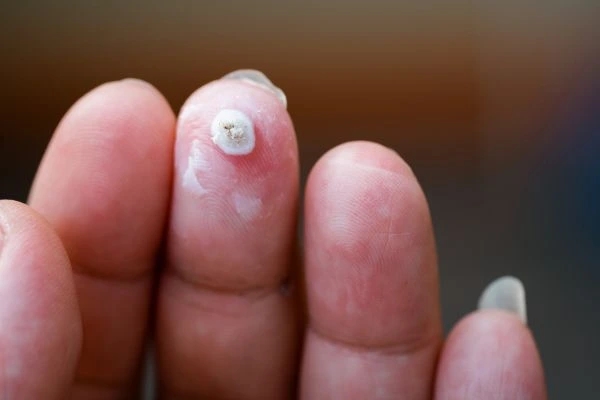 wart on person finger - cryotherapy to treat from LA LIPO Greater London (Hackney)