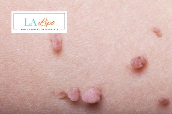 Does cryopen skin tag removal Greater London (Hackney) hurt? Find out now call our team today!