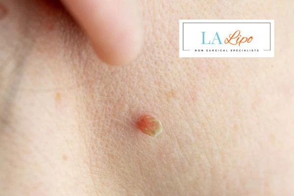 Book skin tag removal Greater London (Hackney) today speak to our team now!