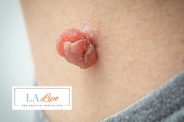 Interested in skin tag removal Greater London (Hackney)? Concerned about the pain? Find out more today!
