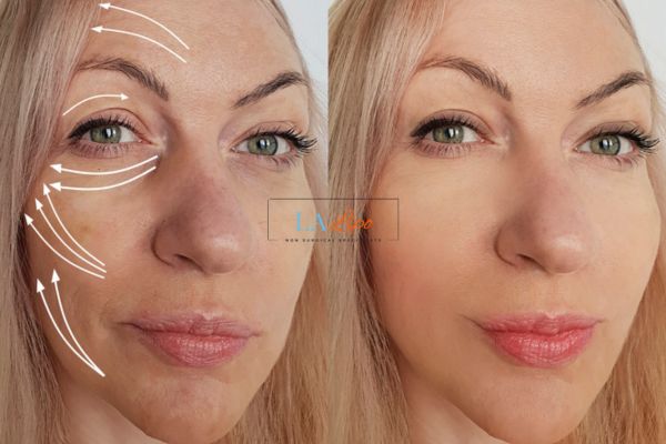 Morpheus 8 results Greater London (Hackney) face lift.