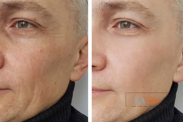 See the amazing results of Morpheus8 Treatment Greater London (Hackney)!