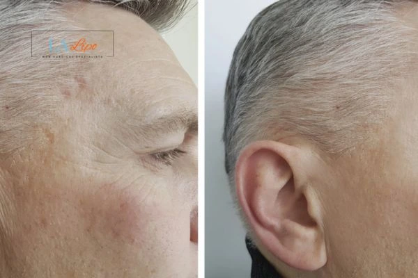 Mens Before & After Morpheus 8 Results Greater London (Hackney)