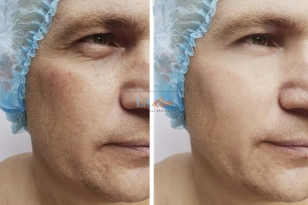 Before and after Morpheus 8 Results Greater London (Hackney)