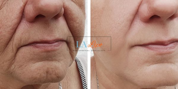 Older lady deeper wrinkle reduction - LA LIPO Morpheus 8 Results Greater London (Hackney)
