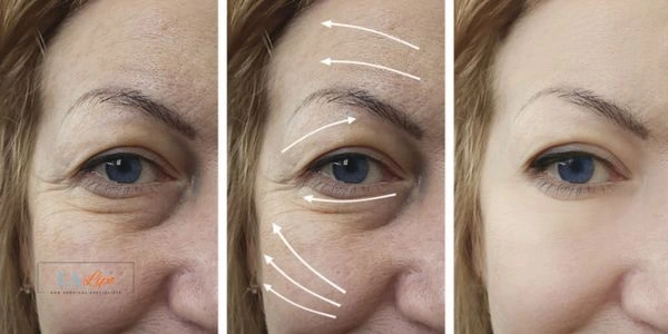 Amazing eye lift Morpheus 8 results Greater London (Hackney)