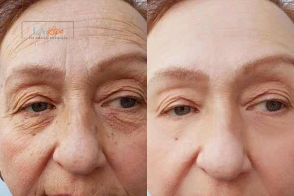 The powerful benefits of Morpheus8 Treatment Greater London (Hackney) - Call Our team today!