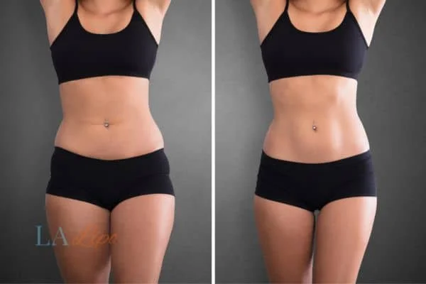 before and after results of non-surgical treatment to help a woman's body image and mental health Greater London (Hackney)