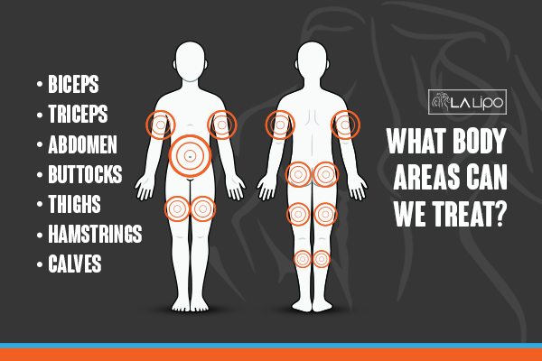 Diagram to show areas you can have LA-EMS Body Sculpting Treatment Greater London (Hackney)