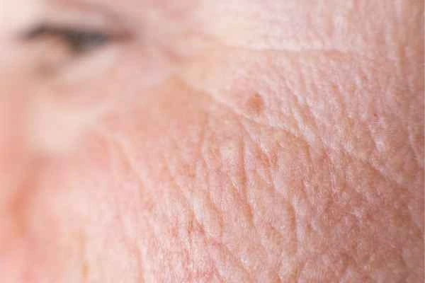 close up picture of a woman's face showing an age spot Greater London (Hackney)