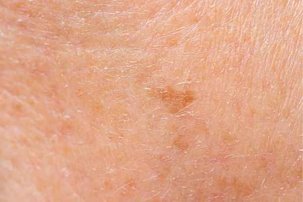 close up picture of age spots Greater London (Hackney)