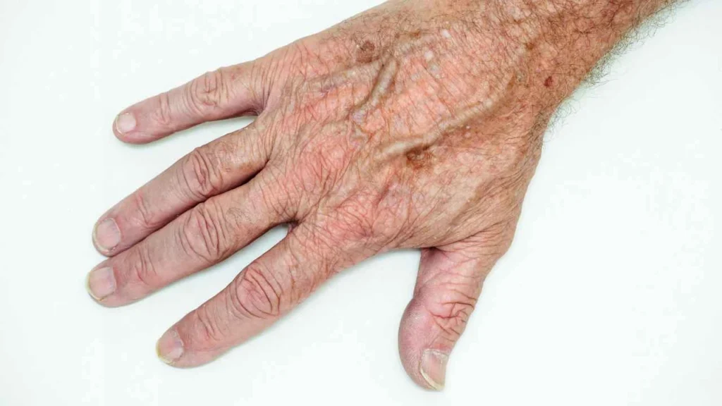 Male hand showing age spot Greater London (Hackney)