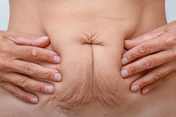 Should I Combine Diastasis Recti Treatment with Body Contouring for Better Results Greater London (Hackney)?