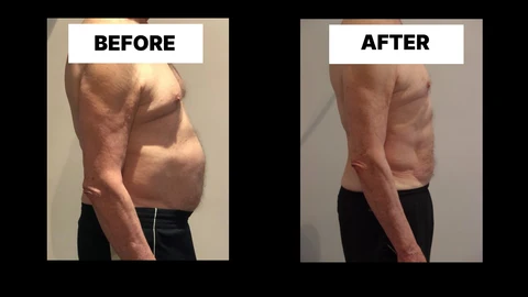 What Symptoms Can Diastasis Recti Cause in Men? Weak Core, Back Pain and Poor Posture Greater London (Hackney)